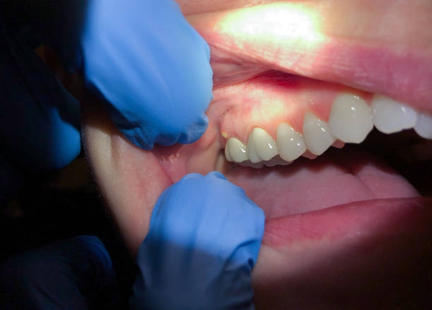 Best Knocked-Out Tooth Emergency  in Satellite Beach, FL